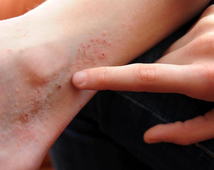 Dermatite atopica,costi da 4 ai 20mila euro annui a paziente