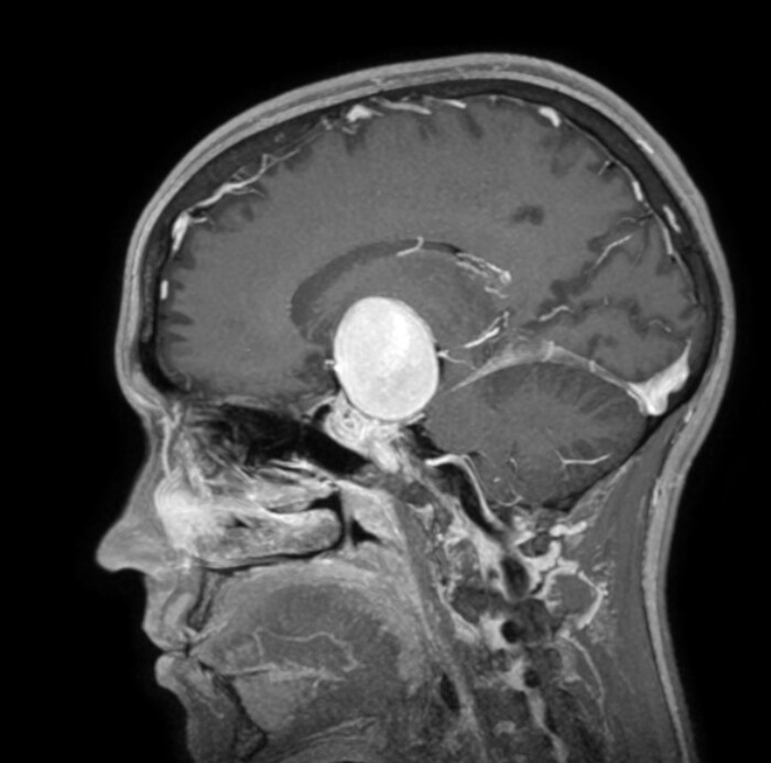 Aneurisma gigante rimosso con tecnica 3D da cervello di 24enne