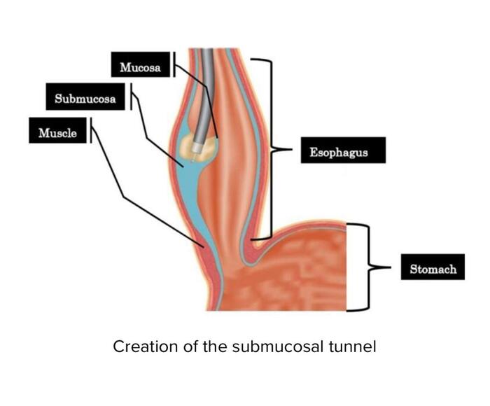 Gastroenterologia, due interventi innovativi all'esofago